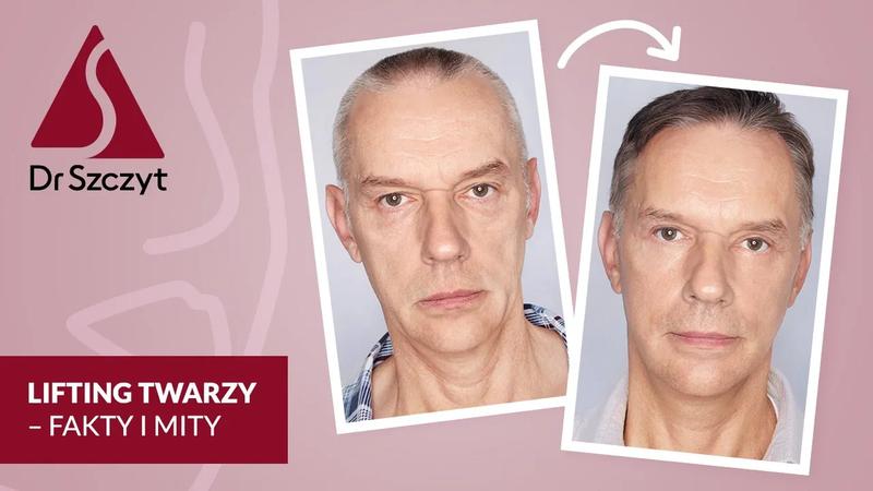 Długotrwałość efektu liftingu