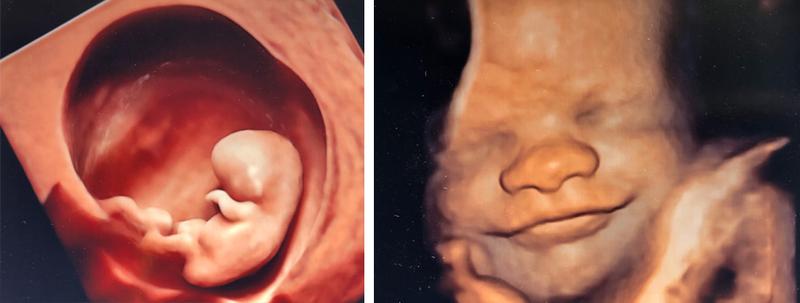 Cele i procedura USG połówkowego