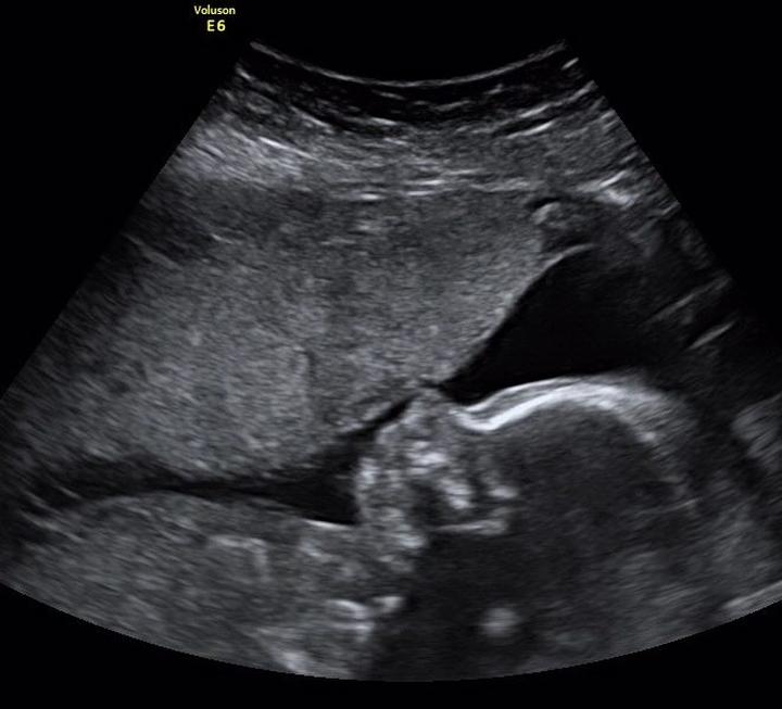 USG połówkowe w ciąży